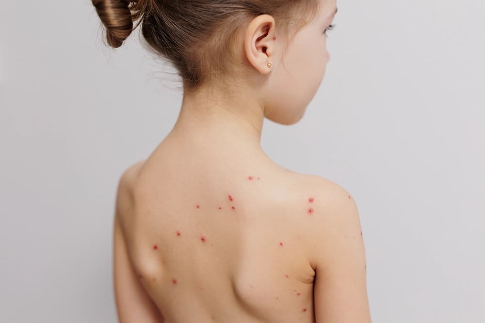 chickenpox