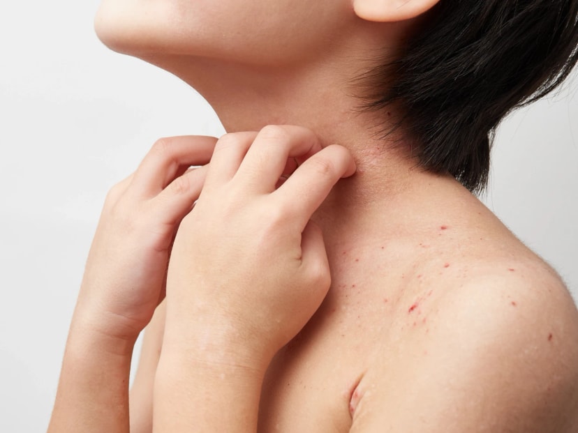 Impetigo