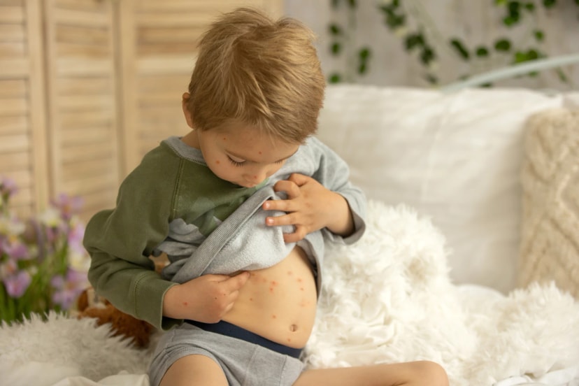 Chickenpox vaccine